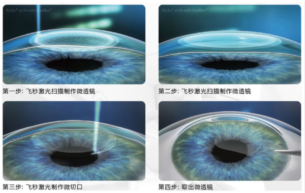 全飞秒smile3.0助你成就学子梦