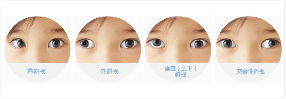 小孩斜弱视如何?