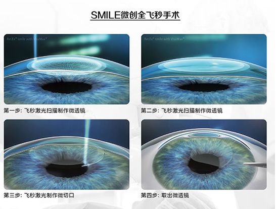 近视眼激光手术有哪些？专家告诉你哪种手术适合你