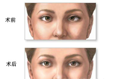 成人斜弱视需要多少钱?如何?