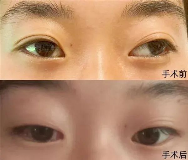 天真无“斜”儿童眼病救助项目 第二批16名斜视儿童已